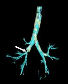 Stenosis