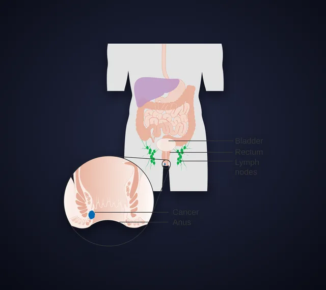 Anal cancer
