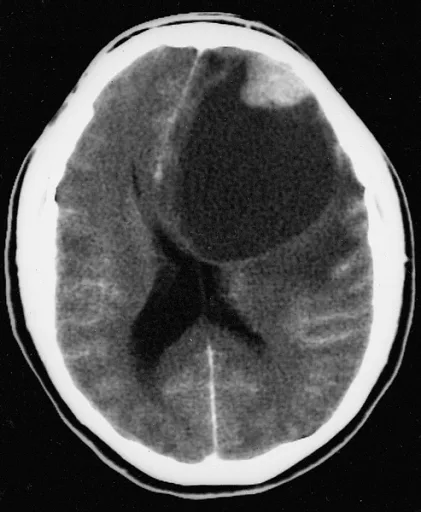 Pleomorphic xanthoastrocytoma