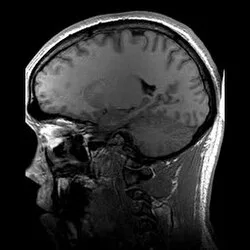 Magnetic resonance imaging
