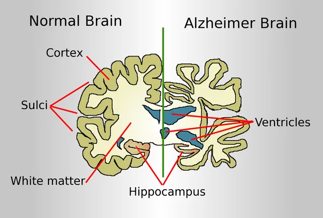 Maladie d'Alzheimer