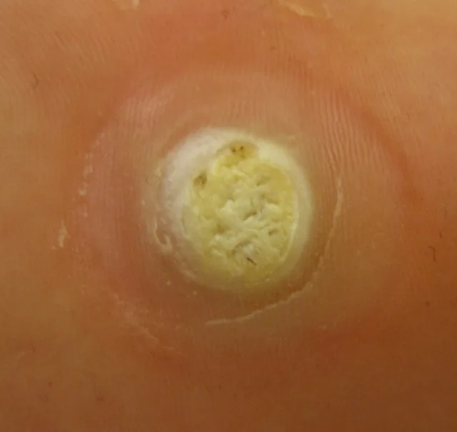 Verruca plantaris