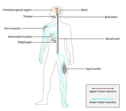 Amyotrophic lateral sclerosis