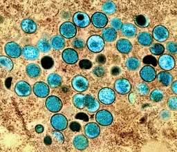 Monkeypox virus