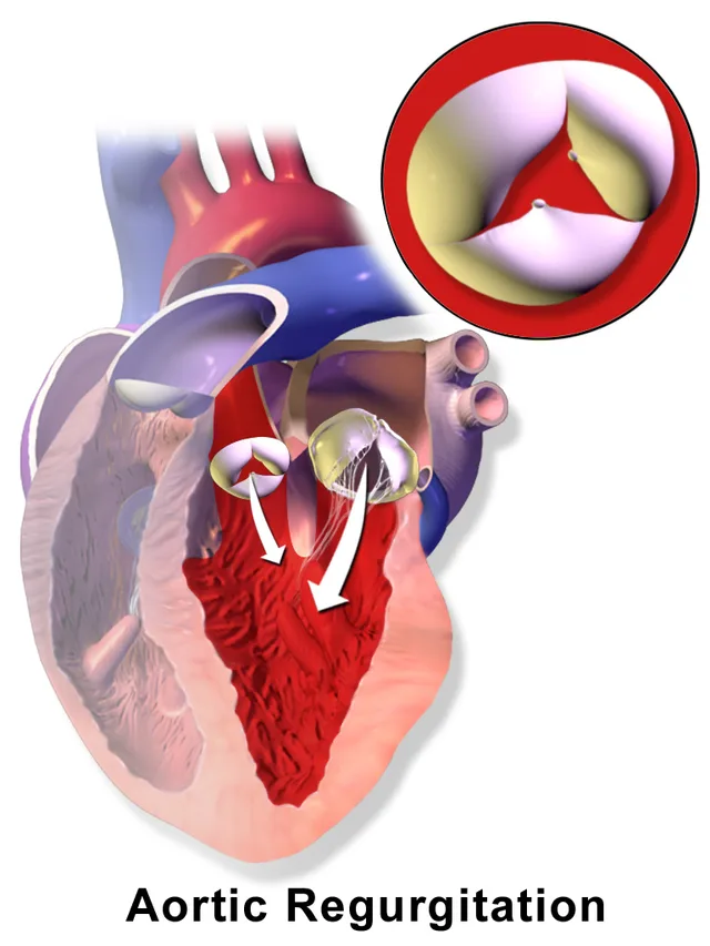 Aortic regurgitation